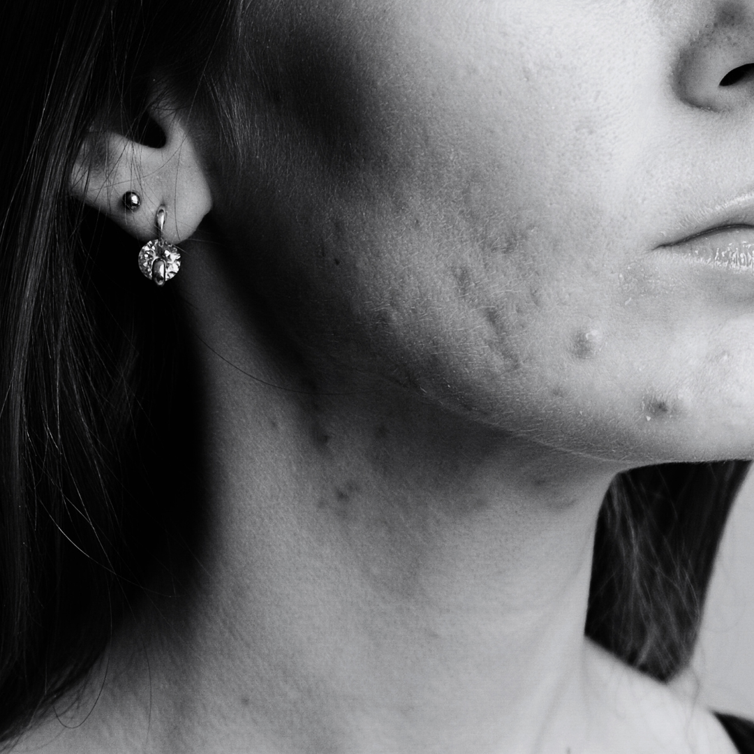 Acne Bootcamp — 12 Weeks to Clearer Skin