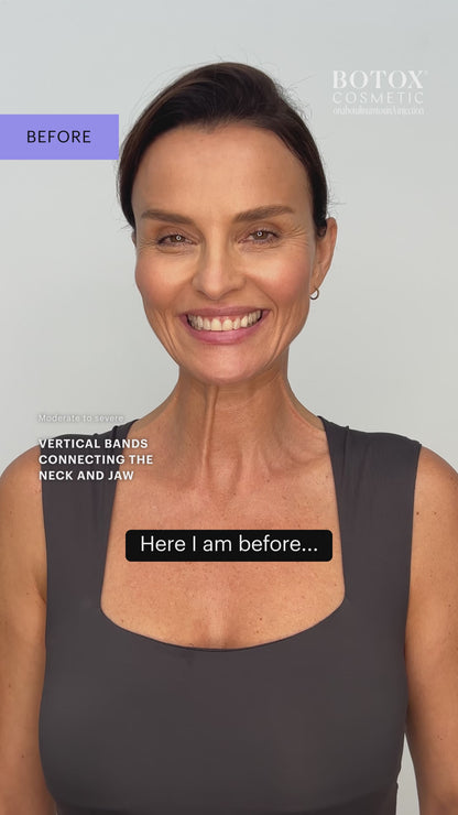 BOTOX® Cosmetic