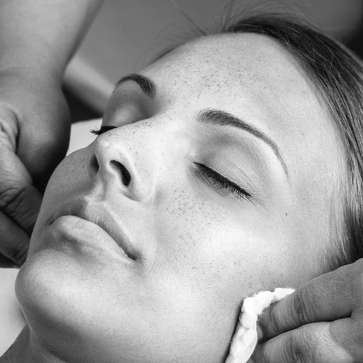 VI Peel — Medium-Strength, Medical-Grade Chemical Peel